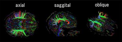 Detection and Growth Pattern of Arcuate Fasciculus from Newborn to Adult